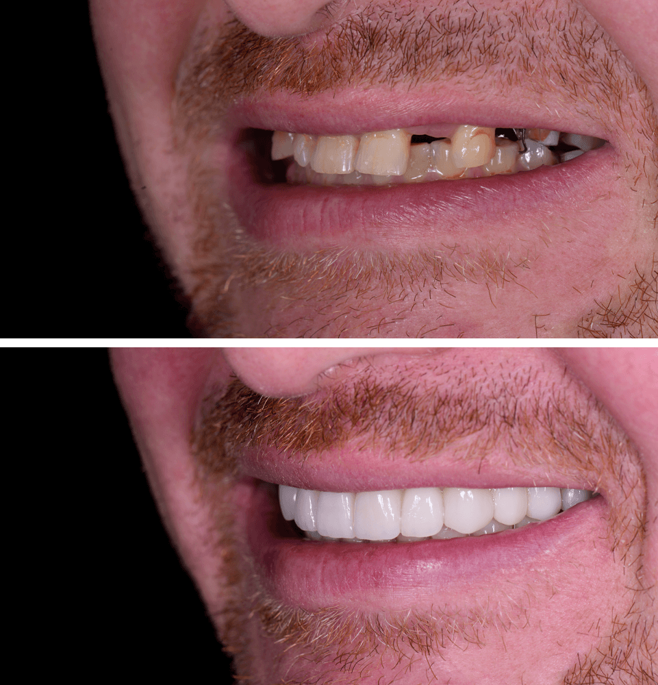 dental implants before and after