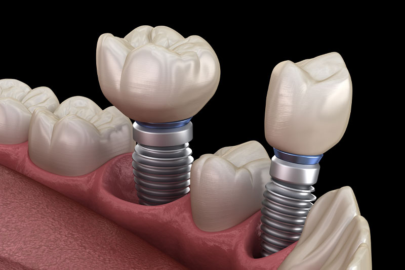 dental implant model