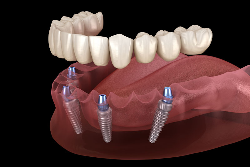 full arch dental implant model