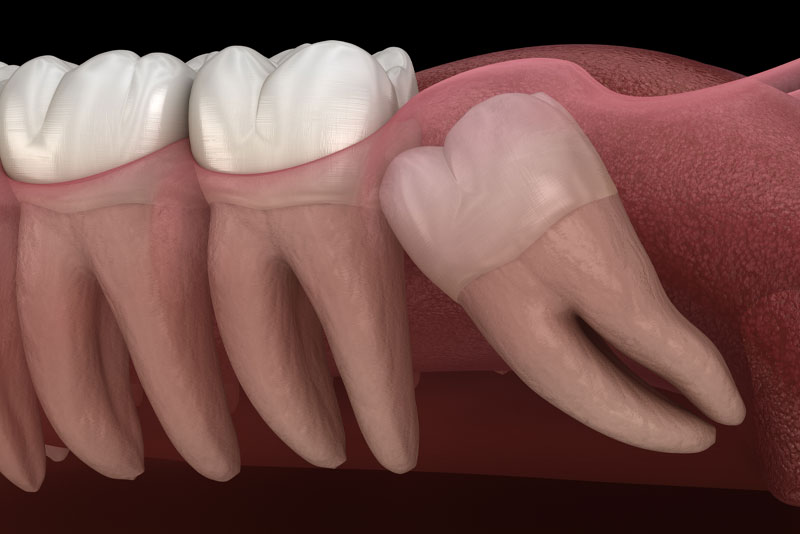 wisdom tooth graphic