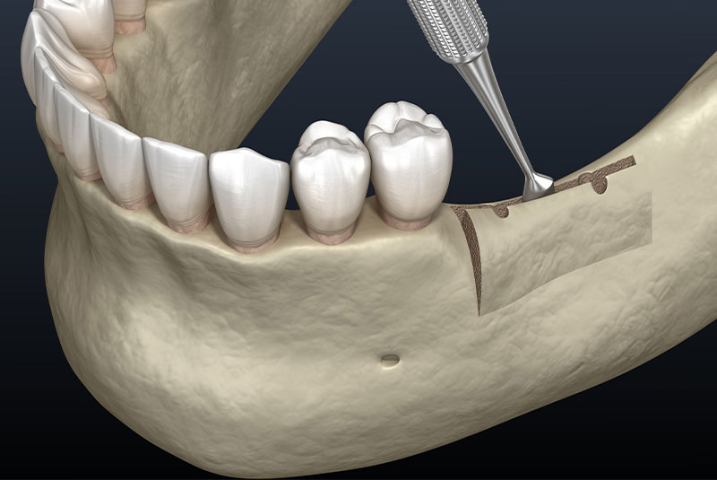 ridge augmentation