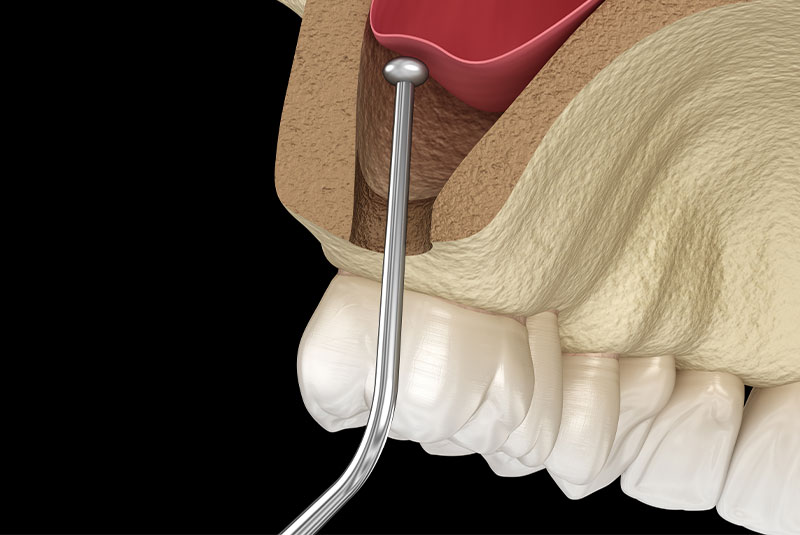 sinus lift
