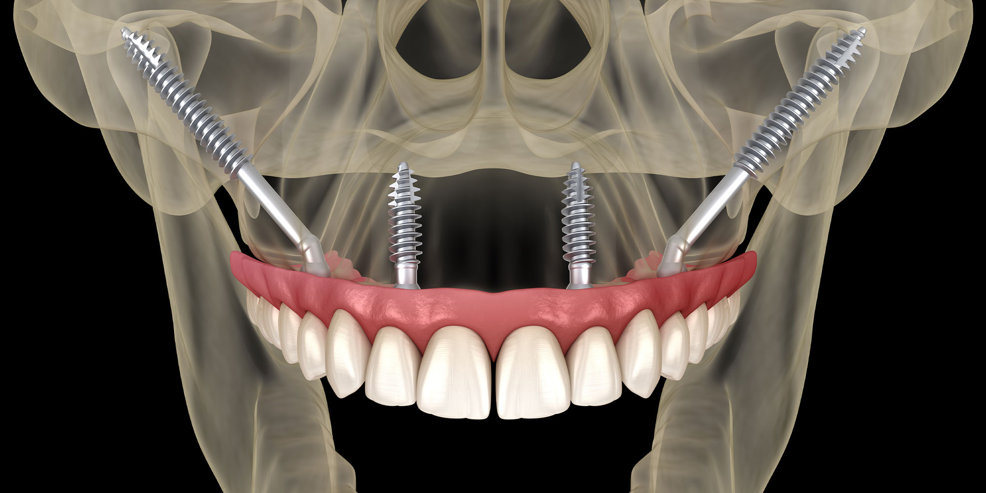 zygomatic implant model